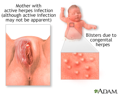 herpes genital warts. warts Genital+herpes+